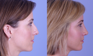 Rhinoplasty