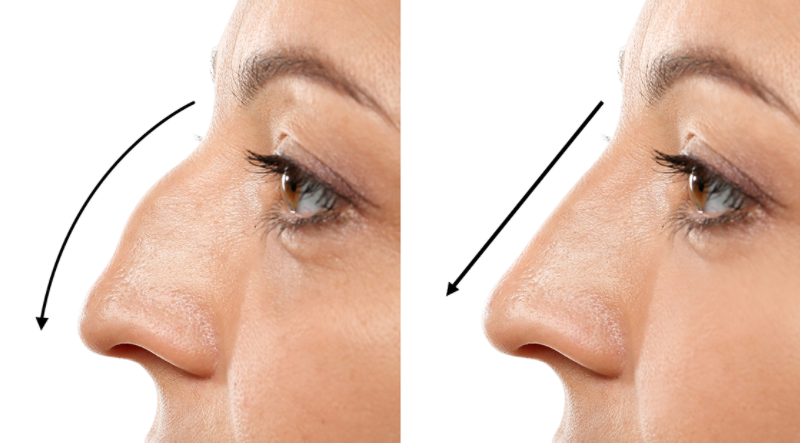 Rhinoplasty