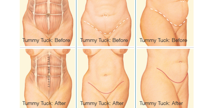 stomach liposuction